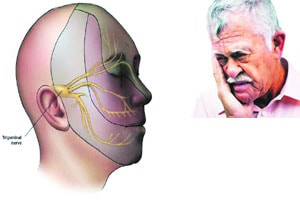 चेहऱ्याच्या नसेची जीवघेणी कळ – ट्रायजेमिनल न्यूरॉल्जिया