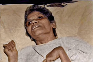 अरुणा शानभाग यांची प्रकृती गंभीर