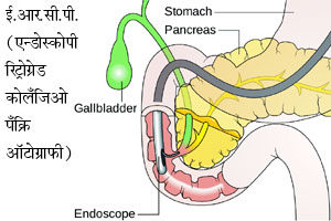 एन्डोस्कोपीतील नवीन उपचार पद्धती