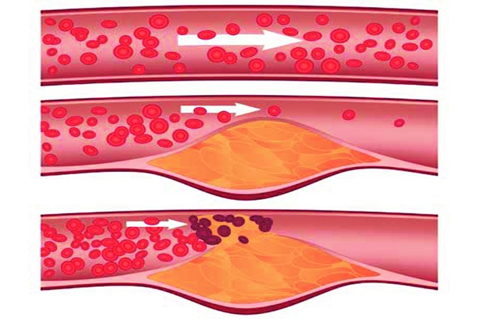 रक्तवाहिन्यांमधील अडथळे आणि परिणाम