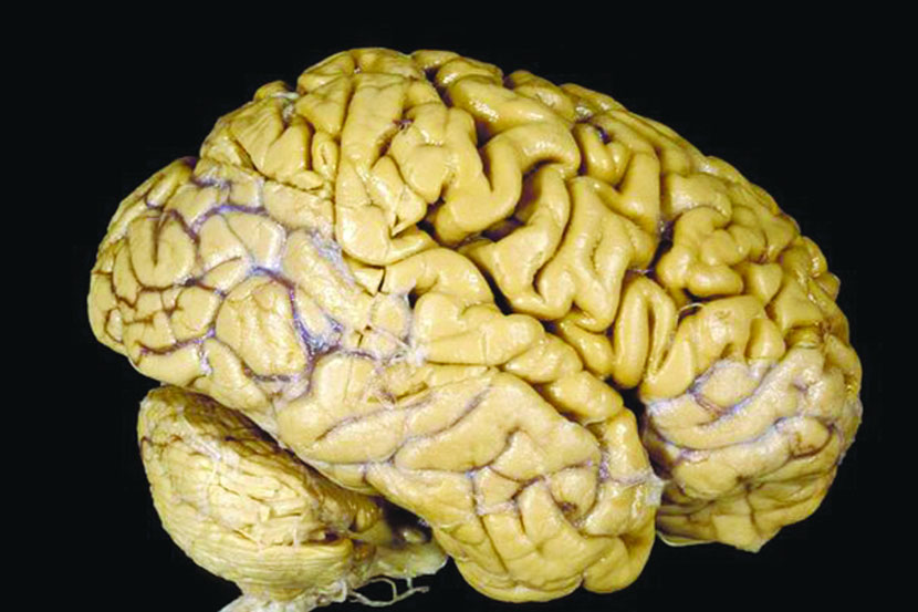 गांजाच्या व्यसनाचा मेंदूतील माहिती प्रक्रियेवर परिणाम
