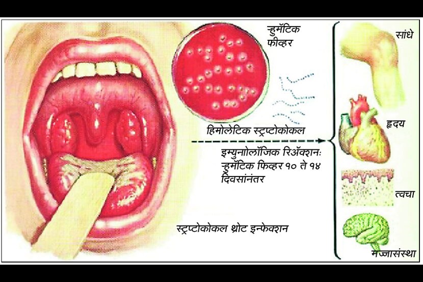ऱ्हुमॅटिक फीव्हर