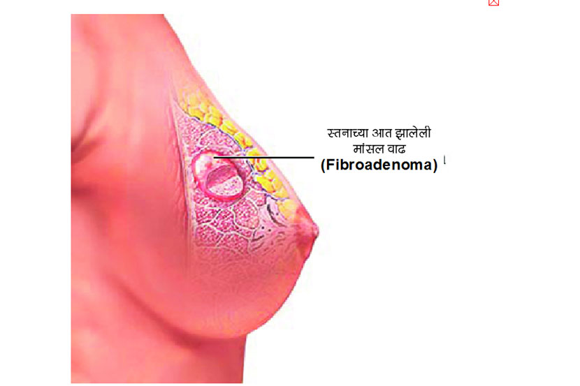 प्रकृ‘ती’ : स्तनांचे आजार