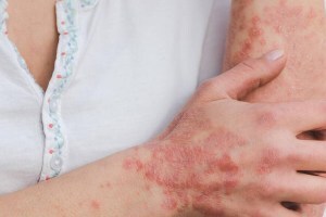 Psoriasis