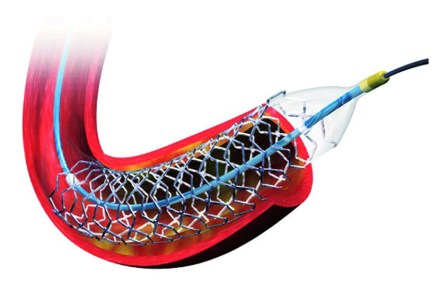 Types of Stents