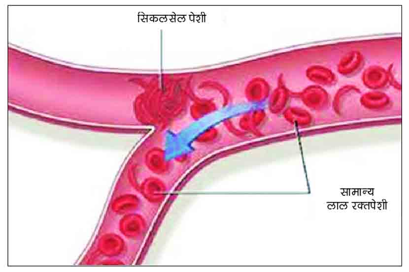सिकलसेल हा एका पिढीतून पुढच्या पिढीत जाणारा रक्ताशी संबंधित आजार आहे.