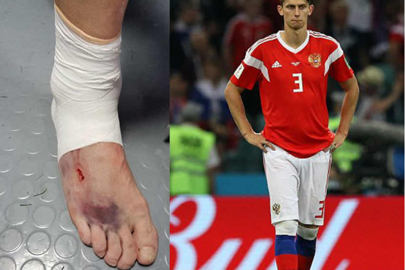FIFA World Cup 2018 : देशासाठी काहीपण! रक्ताळलेल्या पायाने खेळत राहिला सामना