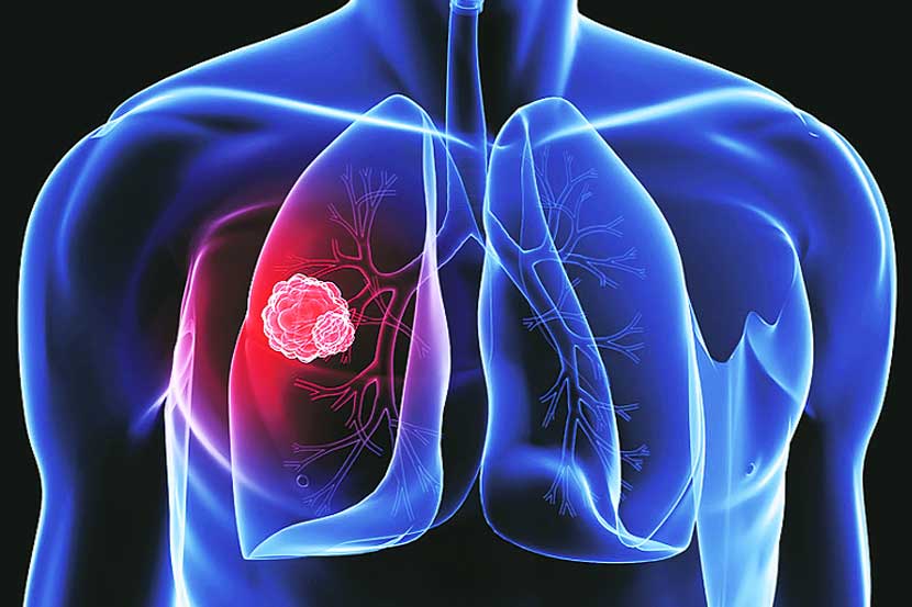 World Cancer Day : वेळीच उपाचर केल्यास फुप्फुसांच्या कर्करोगामुळे होणाऱ्या मृत्यूस प्रतिबंध