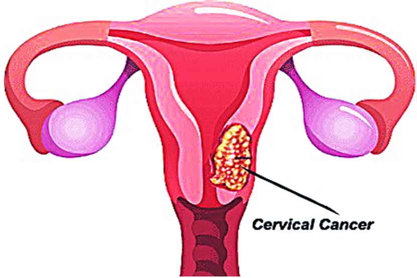 आजारांचे कुतूहल  : गर्भाशयाचा कर्करोग