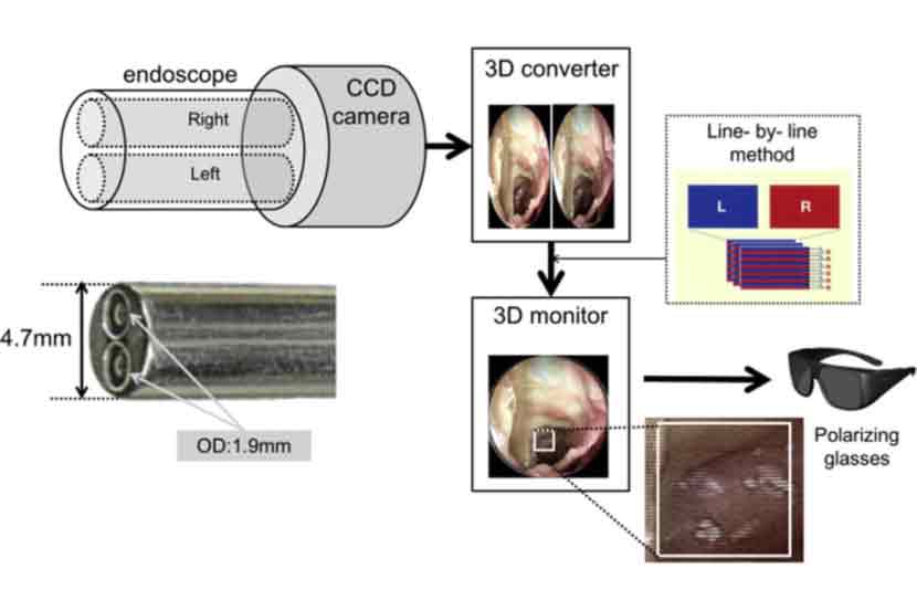 अचूक प्रतिमांसाठी भिंगरहित त्रिमितीय एण्डोस्कोप