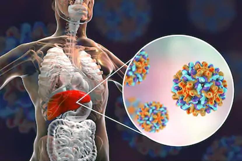 world hepatitis day: हेपेटायटीस म्हणजे काय? जाणून घ्या लक्षणे आणि उपाय