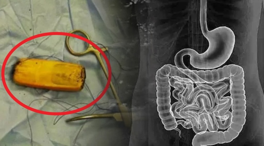 patient swallowed mobile phone