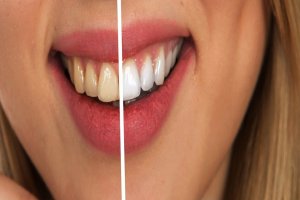 Dental Care Tips