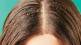 home remedy on dandruff