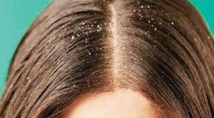 home remedy on dandruff