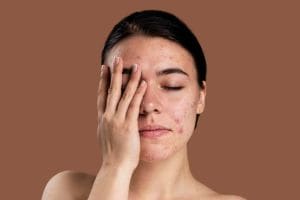 pimple skin freepik