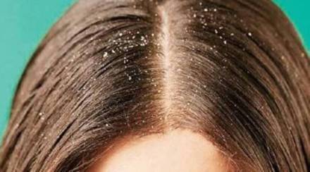 dandruff (1)