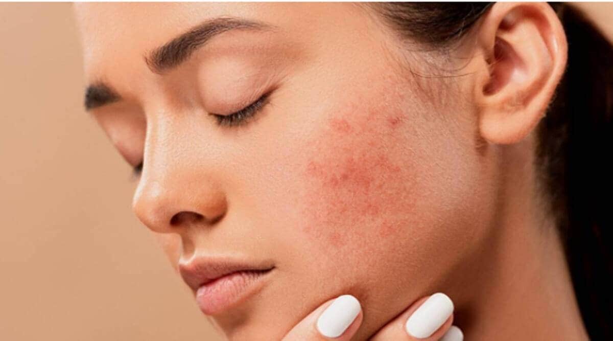 baba ramdev yoga asanas to treat pimples
