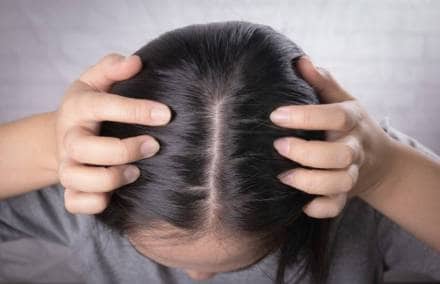 scalp-acne