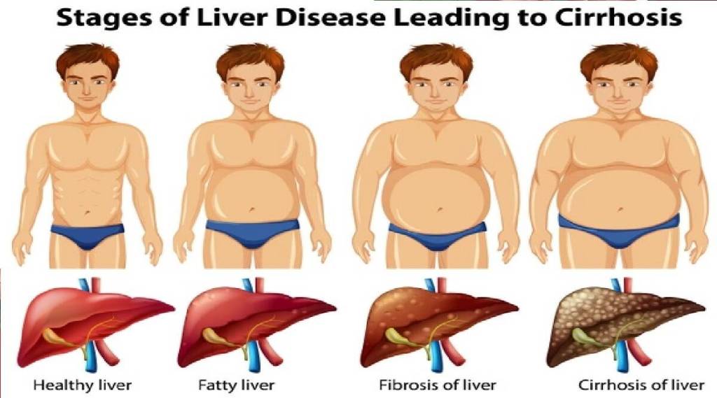Fatty Liver,
