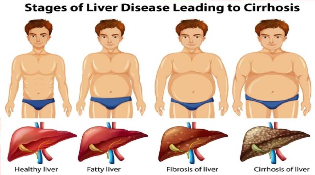 Fatty liver,