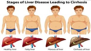 Fatty Liver,