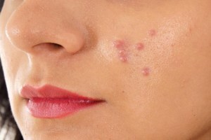 Pimples