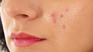 Pimples