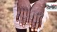 What is Monkeypox