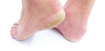 टाचांना भेगा पडण्याचे सर्वात मोठे कारण म्हणजे पाय स्वच्छ न करणे, कोरडी त्वचा, हार्मोनल असंतुलन आणि विशिष्ट जीवनसत्त्वांचा अभाव. (photo: file photo)