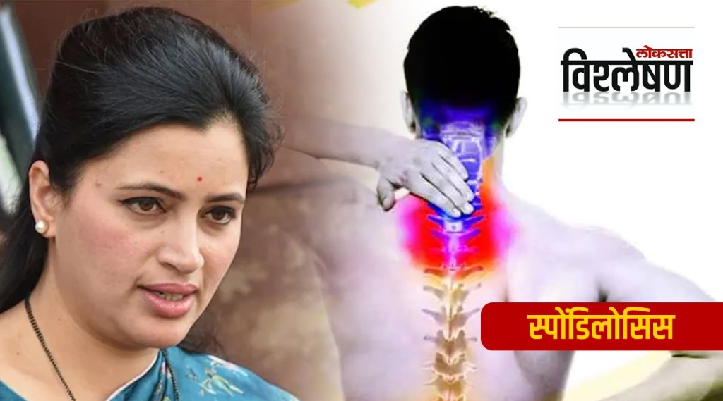 spondylosis navneet rana