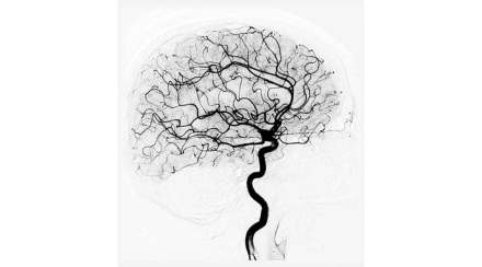 मेंदूतील रक्तवाहिन्यांचे चित्रांकन (अँजिओग्राफी) 