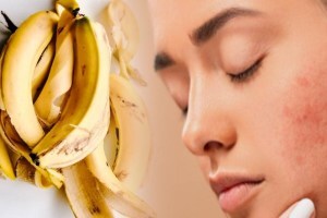 Banana Peel For Acne
