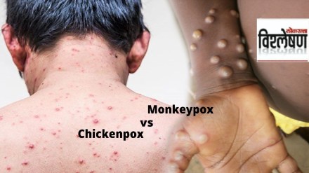 Monkeypox or Chickenpox