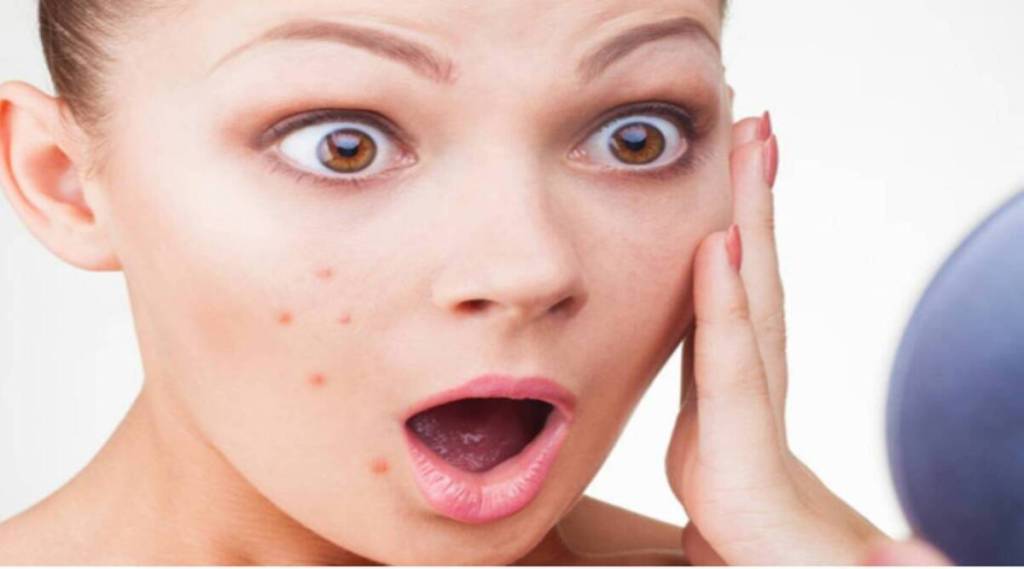 Vitamin D च्या कमतरतेमुळे चेहऱ्यावर येतात पिंपल्स; जाणून घ्या यावर योग्य उपचार