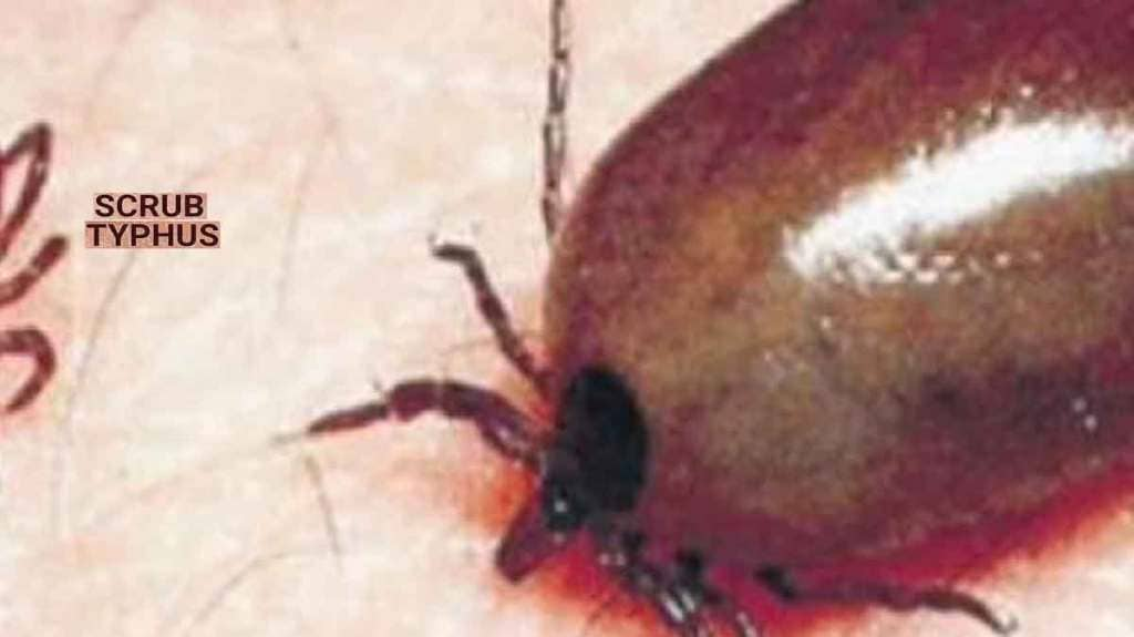 scrub typhus disease in buldhana