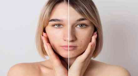 Baking soda Remedi for Pimples