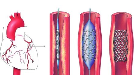 Angioplasty on a 21-year-old man with chest and back pain