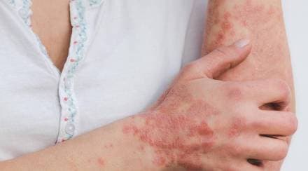 Psoriasis Skin Disease Symptoms