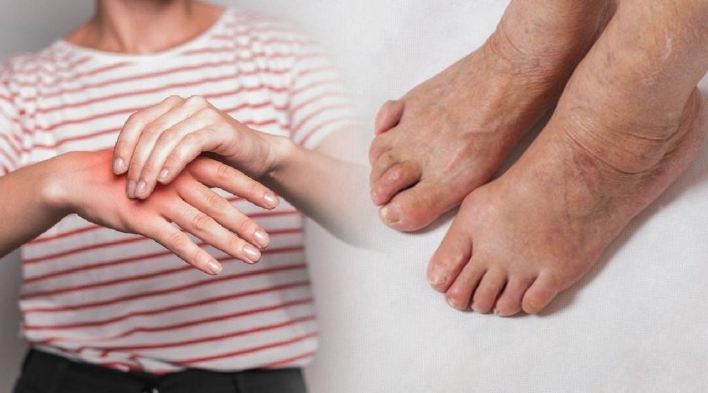 hand feet swelling