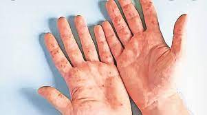 Increase in 'hand foot mouth' infection among children under five years of age in pune