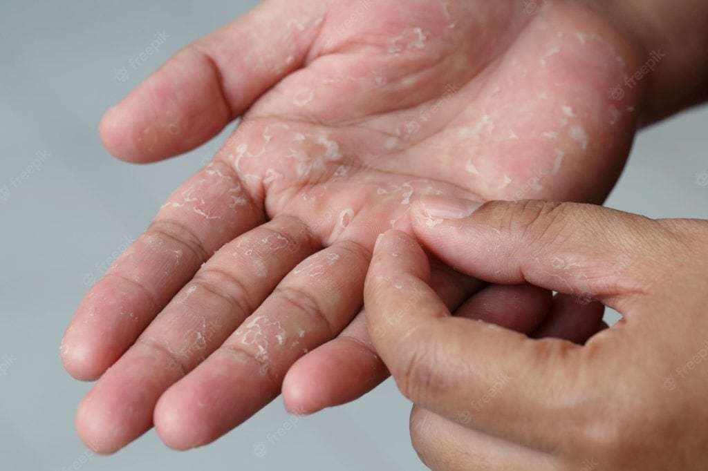 'These' serious reasons can be behind the peeling of the skin on the hands