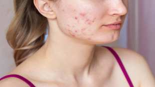 period acne