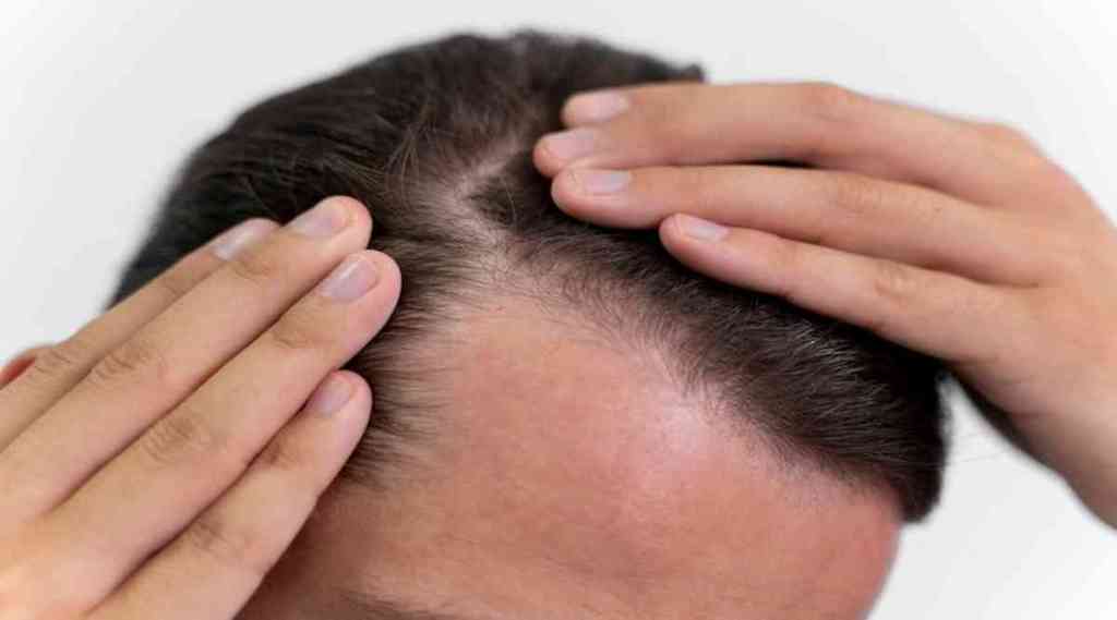 remedies for hair loss