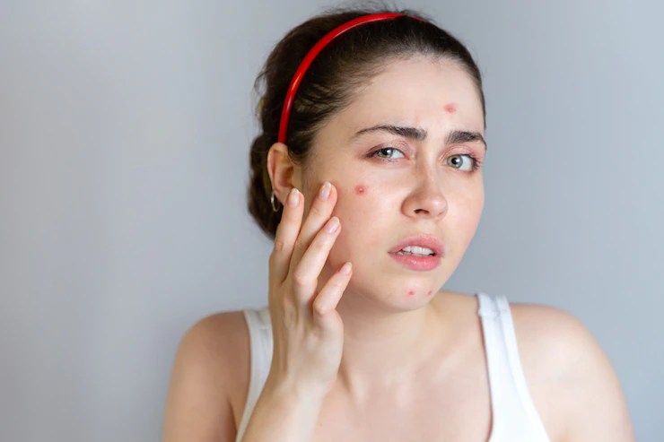 These five morning habits can cause pimples