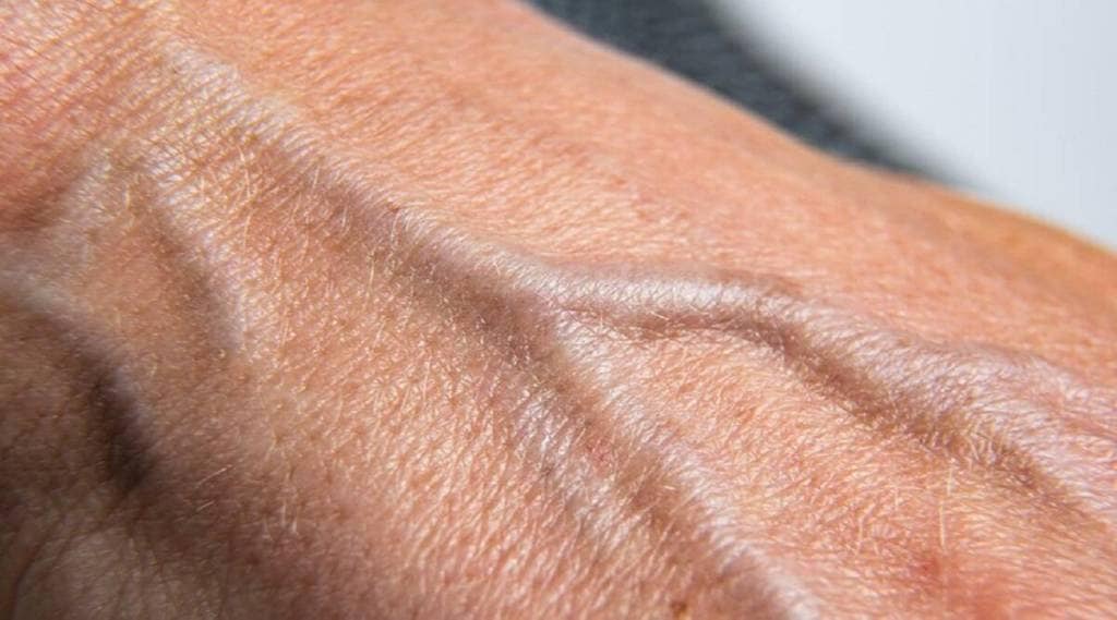 Swollen Veins in Hands: ‘या’ ४ कारणांमुळे हातांच्या नसा फुगायला लागतात; वेळीच जाणून घ्या यावर योग्य उपचार