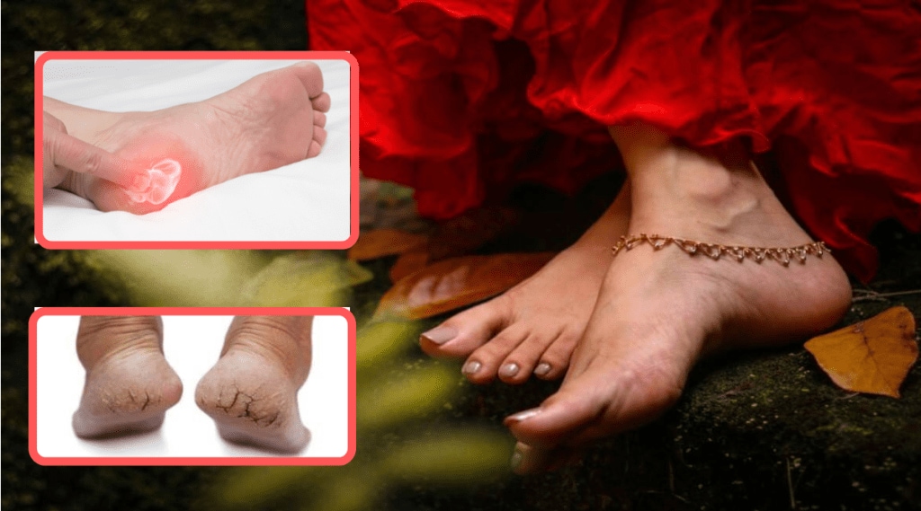 Pain In Legs can happen due to Cracked Heels easy home remedies and pedicure for beautiful feet