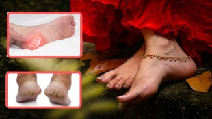Pain In Legs can happen due to Cracked Heels easy home remedies and pedicure for beautiful feet