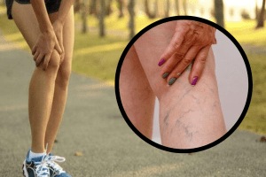 Varicose veins Swelling in feet blood vessels turn blue green how to cure impure blood Ayurvedic Treatment