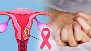 cervical cancer